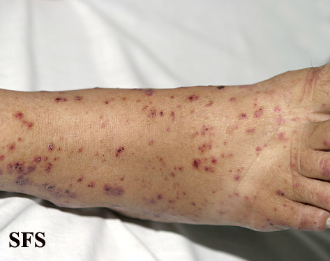 .Allergicvasculitis Adapted from Dermatology Atlas.[1]