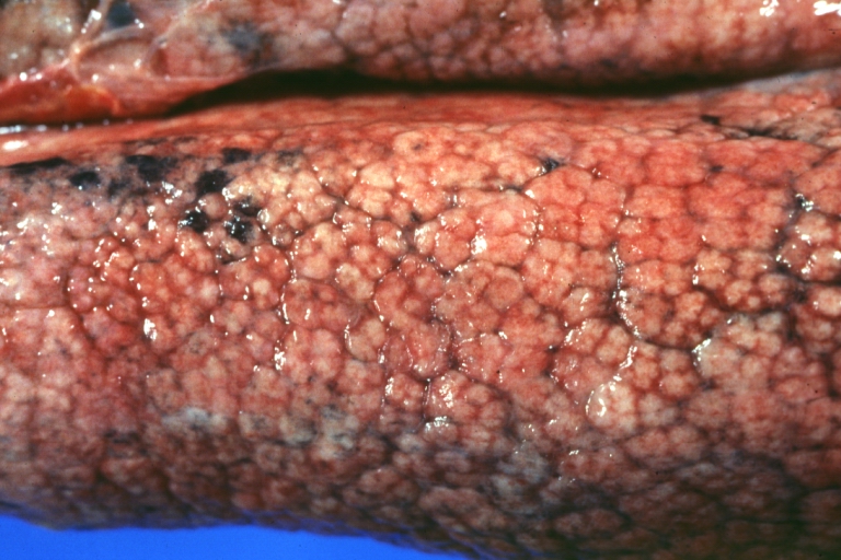 Lung: Idiopathic Interstitial Fibrosis: Gross, natural color, an excellent photo of lung cirrhosis (close-up view)