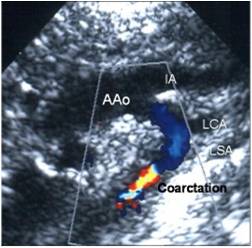 Echocardiogram showing coarctation of aorta