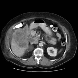 Cholangiocarcinoma is considered less likely due to the lack of biliary obstruction.