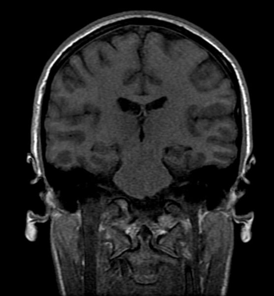 File:Mesial temporal sclerosis 002.jpg