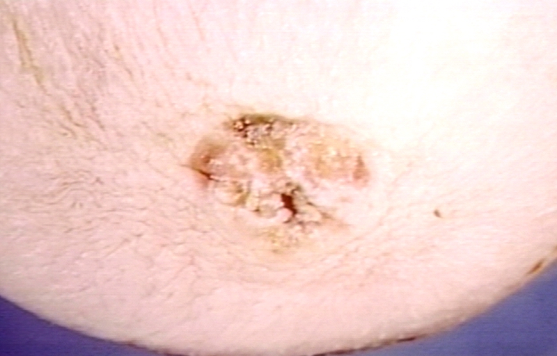 Paget's disease, nipple; Crusted eroded surface, typical lesion. Always with carcinoma.