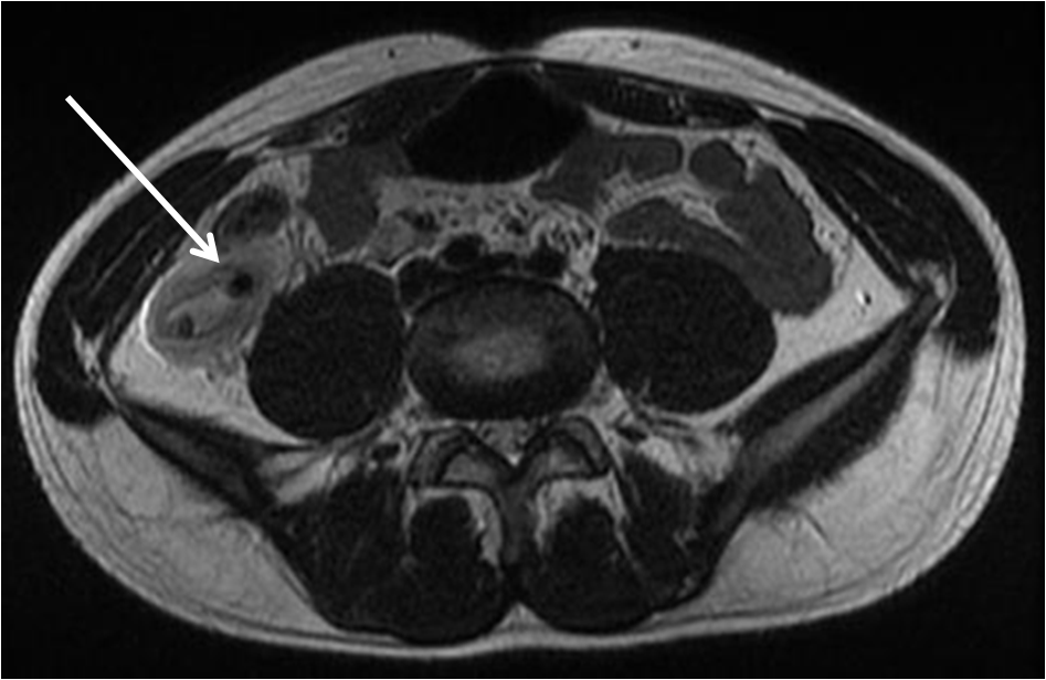 File:Perforated-appendicitis-axial-t2-mr.png