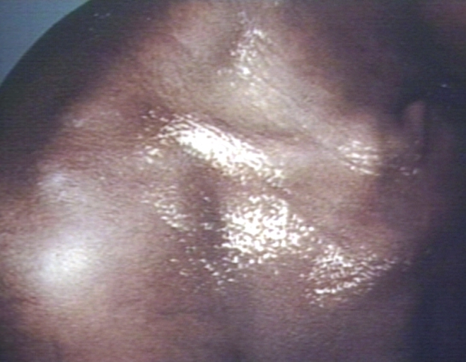 Skin: Scleroderma, chest, salt and pepper pigmentation