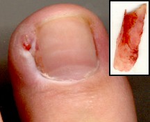 Post-surgery toe with removed nail shard