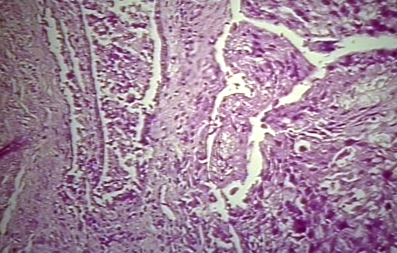 Prostate: Squamous cell carcinoma