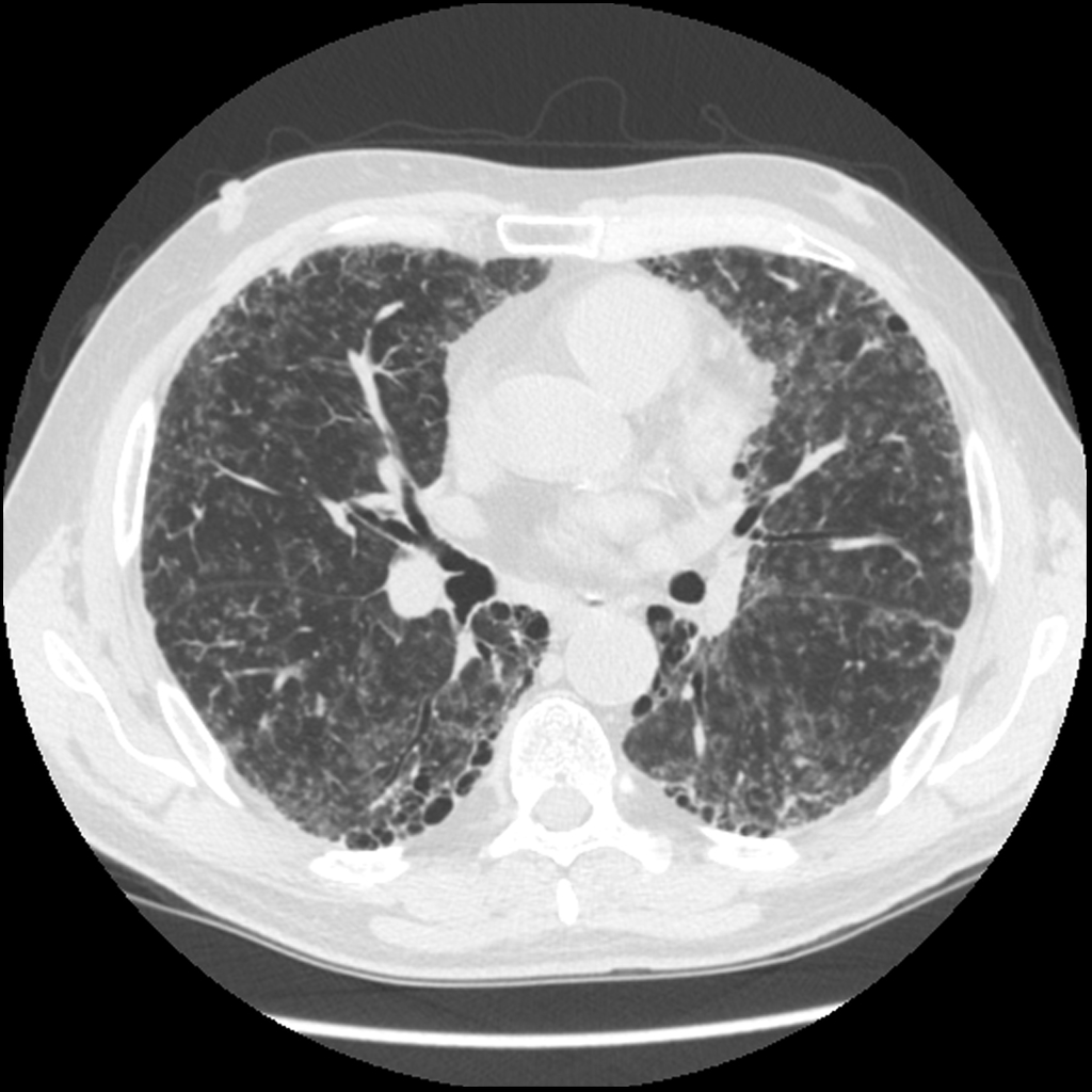 File:Usual-interstitial-pneumonia-in-rheumatoid-arthritis-with-possible-follicular-bronchiolitis (1).jpg