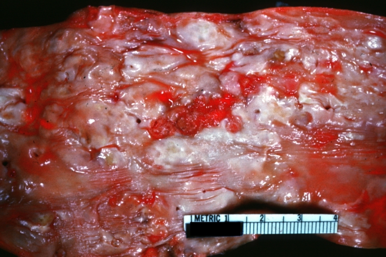 Atherosclerosis: Aorta: Gross, an excellent example of fibrous plaques and mural thrombi