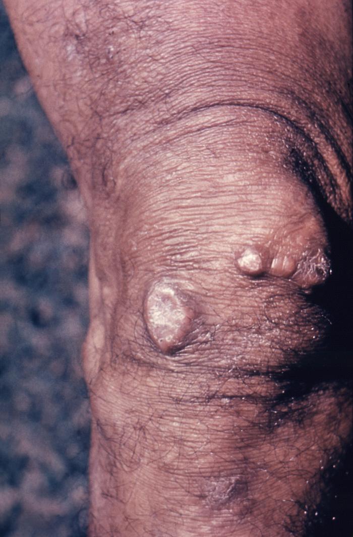 Patient’s right knee revealed the keloidal scarring brought on due to a case of cutaneous blastomycosis, which was caused by Blastomyces dermatitidis. From Public Health Image Library (PHIL). [26]
