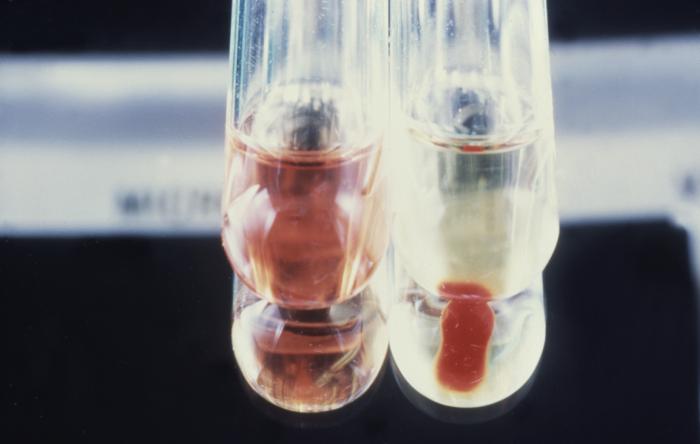 Hemolysis test tubes used for the purpose of isolation and identification of Vibrio cholerae. From Public Health Image Library (PHIL). [8]