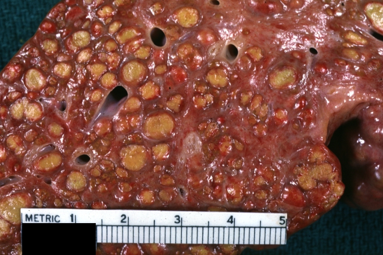 Macronodular cirrhosis: Gross, natural color, cut surface, large irregular bands of fibrosis with variable size liver cell nodules up to about 8 mm and all necrotic appears to be an end stage liver disease.