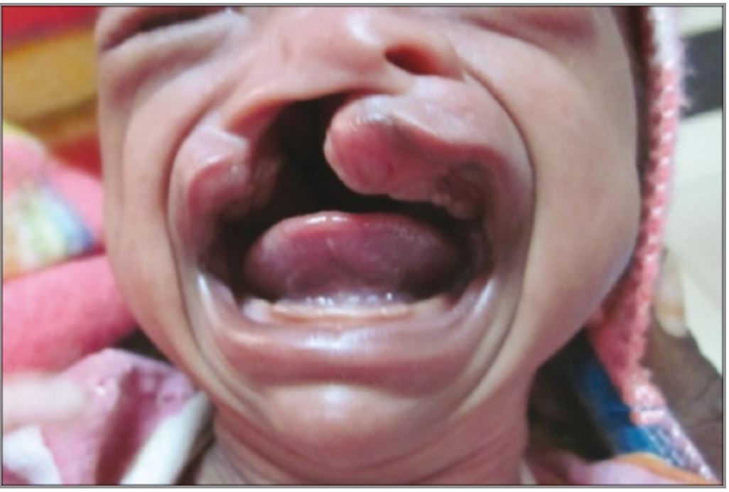 Cleft lip and cleft palate