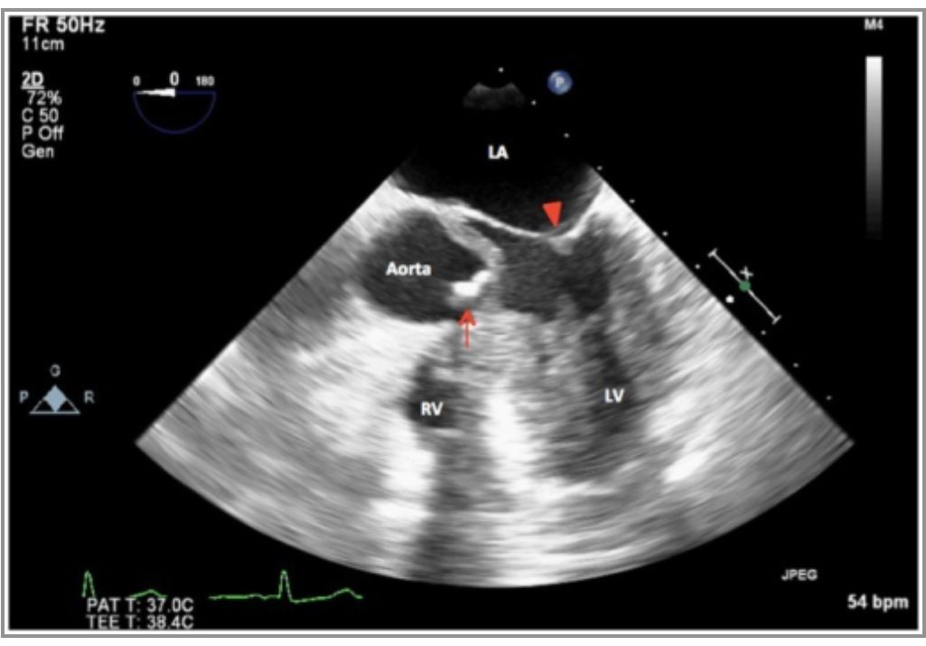 File:Echo Aortic Stenosis seen in Turner Syndrome.JPG