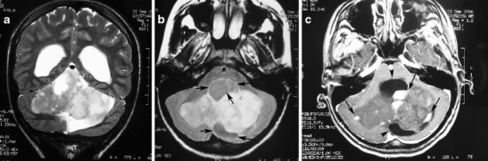 A pilocytic astrocytoma with a predominantly solid mass and a minimal cyst-like component in a 14-year-old girl. a This coronal T2-weighted image shows a large, well-marginated mass, involving the vermis and both cerebellar hemispheres that effaces the fourth ventricle. b On an axial FLAIR image, the solid mass shows high signal intensity with hypointense cystic areas (arrows). c On an axial contrast-enhanced image, the mass shows inhomogeneous contrast enhancement, with nodules that exhibit intense enhancement (arrows) and other cystic areas that remain unenhanced (arrowheads).[2]