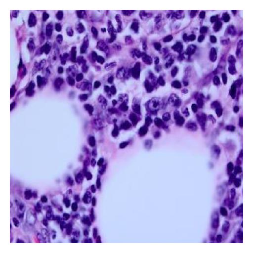 File:Subcutaneous panniculitis-like T-cell lymphoma biospy 3.jpg