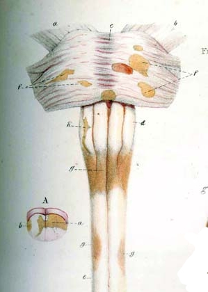 Detail of drawing from Carswell book depicting multiple sclerosis lesions in the brain stemand spinal cord (1838)