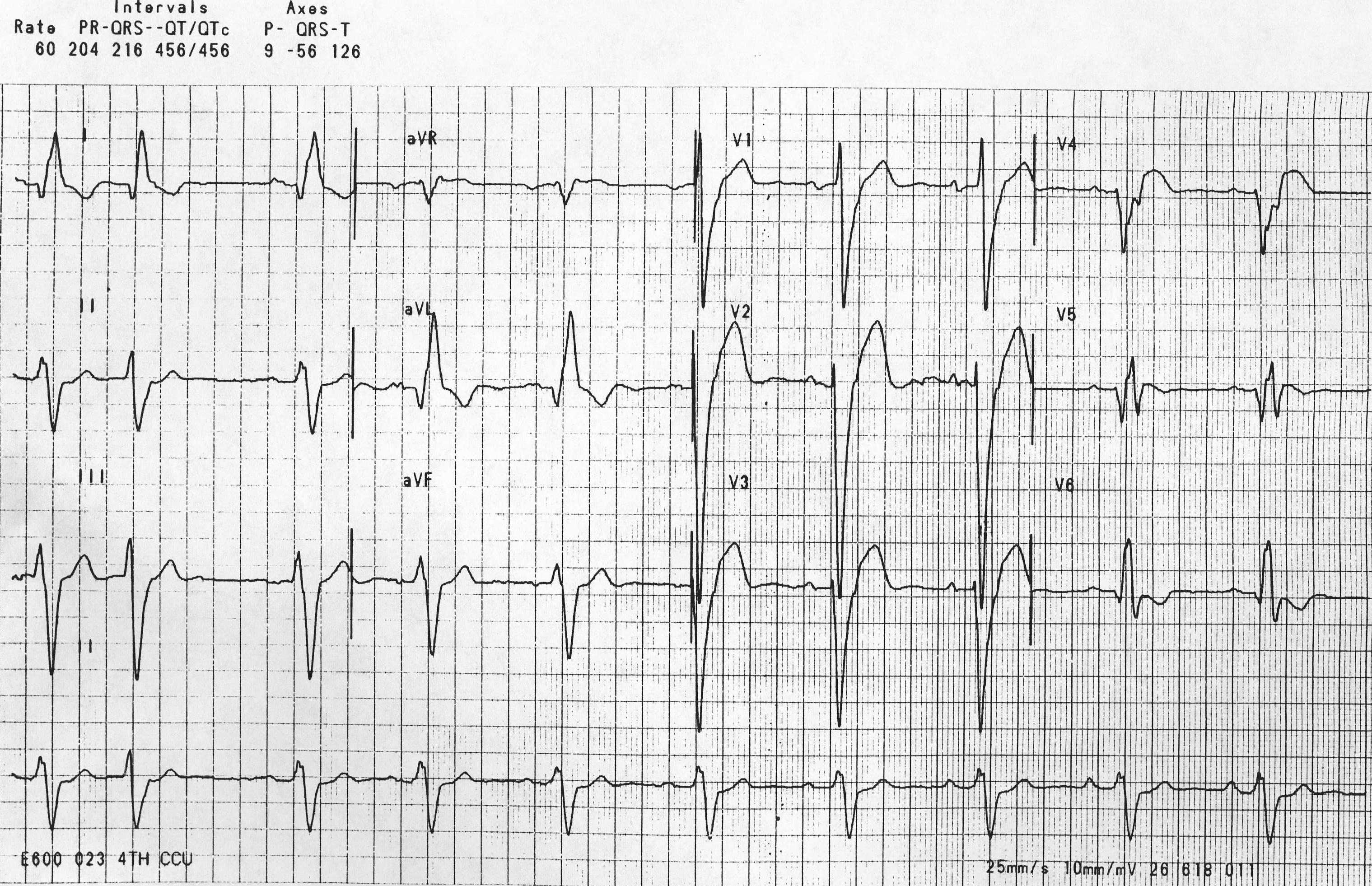 LBBB with Lateral Q waves.CMG.jpg