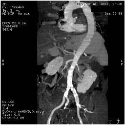 Atherosclerotic plaques seen in the distal aortic arch, aortic bifurcation, and in the external iliac arteries. right renal artery stenosis. 74 year-old male who is status post thromboembolic event of his RLE.