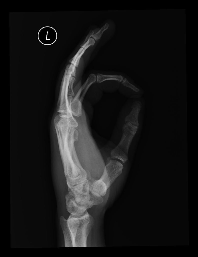 Oblique fracture of the base of the 5th metacarpal bone with 2mm radial displacement of the fractured fragment and proximal displacement of the metacarpal bone by 3mm. The 5th CMC joint is also involved and results in a 3mm step. Soft tissue swelling adjacent to the fracture site is also noted.