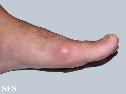 Gout flare affecting first metatarsophalangeal joint[1]