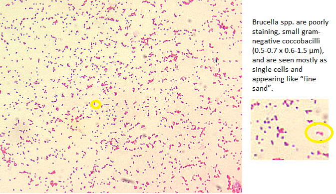 File:Brucellosis histopathology.png