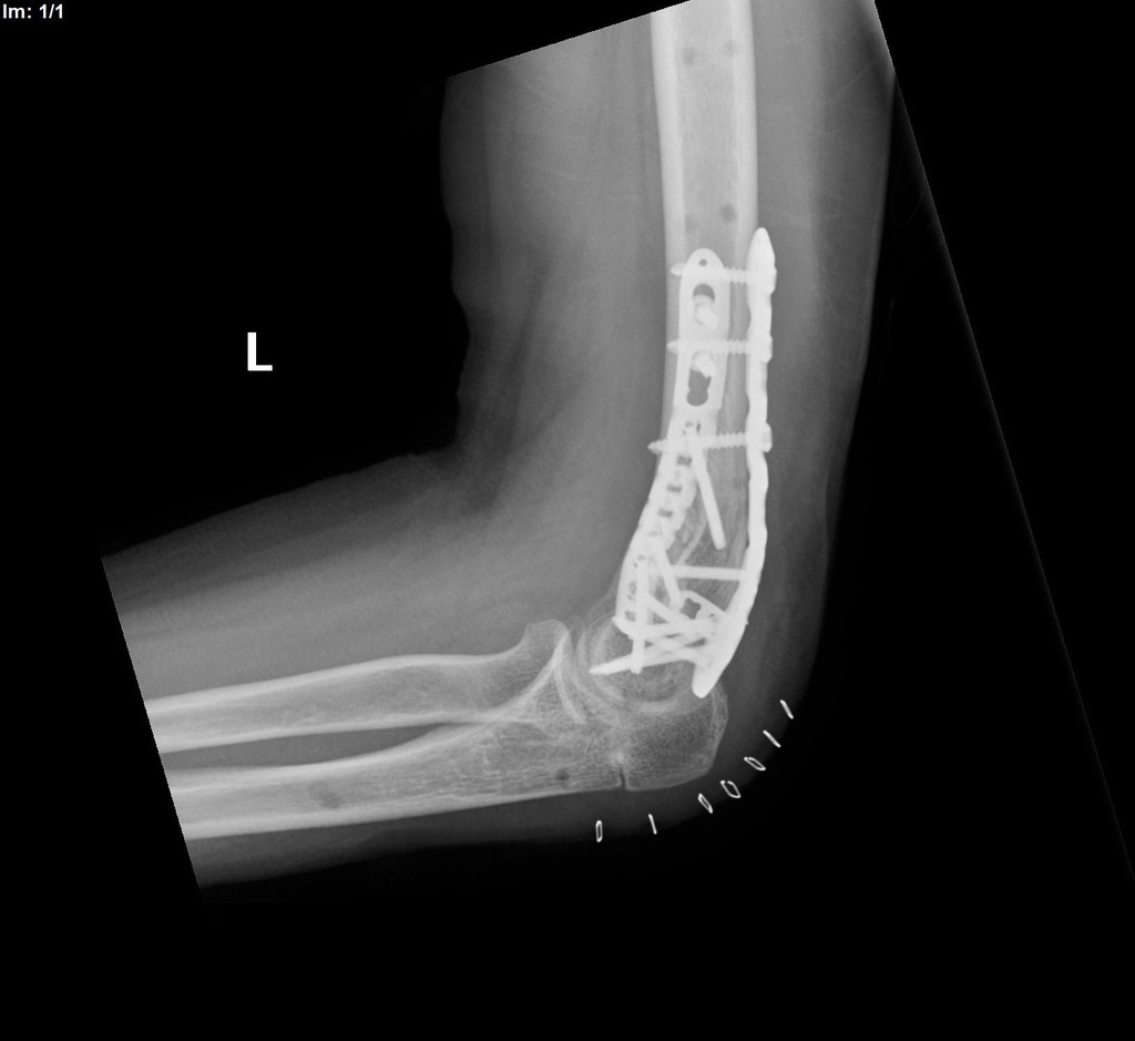 File:Displaced-t-condylar-and-supracondylar-fracture-of-the-distal-humerus (10).jpg