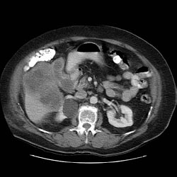 3.5 cm simple cyst associated with the upper pole of the right kidney.