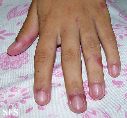 Lupus erythematosus-systemic. Adapted from Dermatology Atlas.[30]