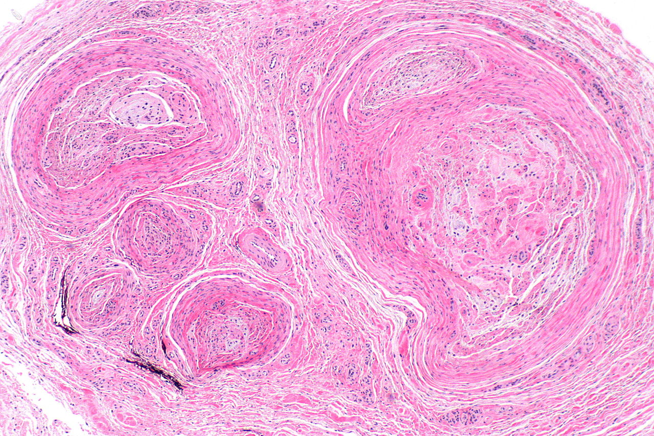 File:Morton neuroma -- low mag.jpg