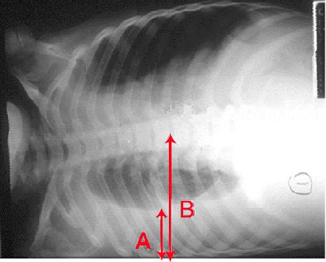 Pleural effusion Chest x-ray of a pleural effusion. The arrow A shows fluid layering in the right pleural cavity. The B arrow shows the normal width of the lung in the cavity - Case courtesy of Dr Vivek Pai, <a href="https://radiopaedia.org/">Radiopaedia.org</a>. From the case <a href="https://radiopaedia.org/cases/27112">rID: 27112</a>