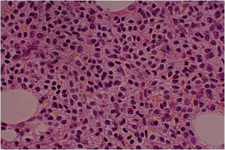 Hairy cell leukemia findings in bone marrow examination