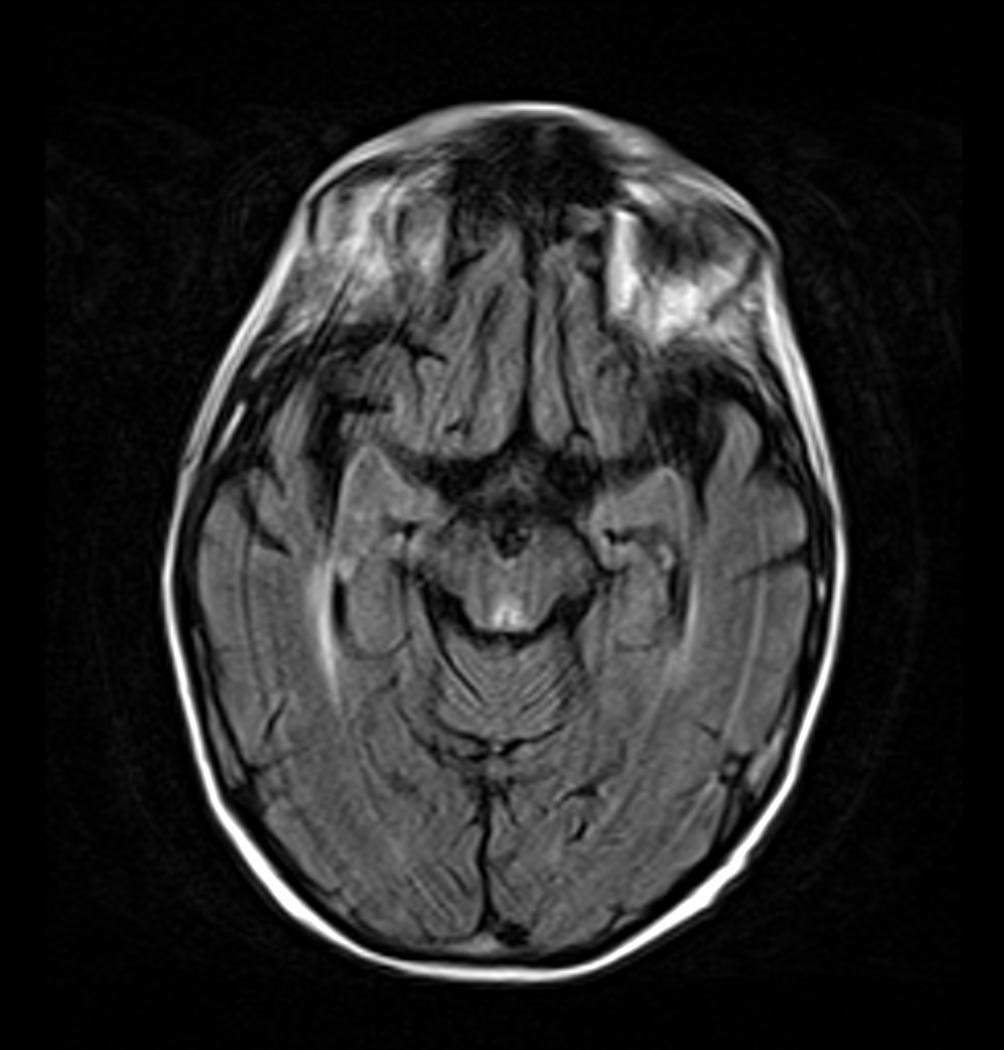 File:MRI FLAIR sequence showing hyperintense signal in the periaqueducal grey matter in Wernicke Encephalopathy.jpg