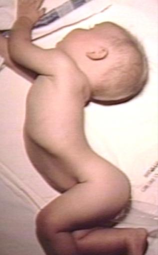 Opisthotonus: Meningitis, One Year Old Child: Pus in Subarachnoid Space causes Neck Muscle Spasms
