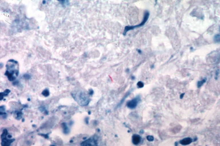 Tuberculous pericarditis: Micro oil acid fast stain. The organism easily seen.