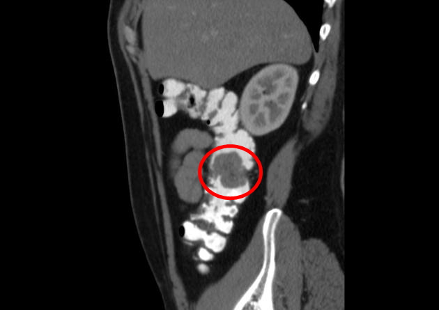 File:Sagittal CT Colon polyps.jpeg