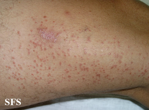 Syringoma From Public Health Image Library (PHIL). [1]