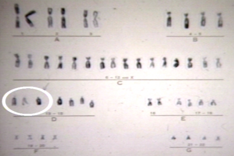 Trisomy 13 karyotype.jpg