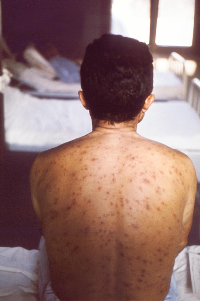 Posterior view of a hospitalized man's neck, back and shoulders, who’d been assigned a bed in a smallpox ward, due to an initially misdiagnosed illness, which turned out to be chickenpox. From Public Health Image Library (PHIL). [23]