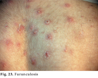 Furunculosis: Group of boils (furuncles). [3]