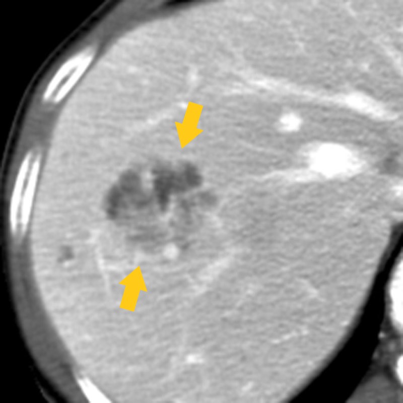 File:Hepatic Adenoma CT (portal venous phase).jpg