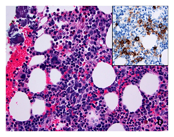 File:Intravascular large B-cell lymphoma pathophysiology image 4.jpg