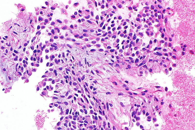 File:Pleomorphic adenoma - cell block -- high mag.jpg