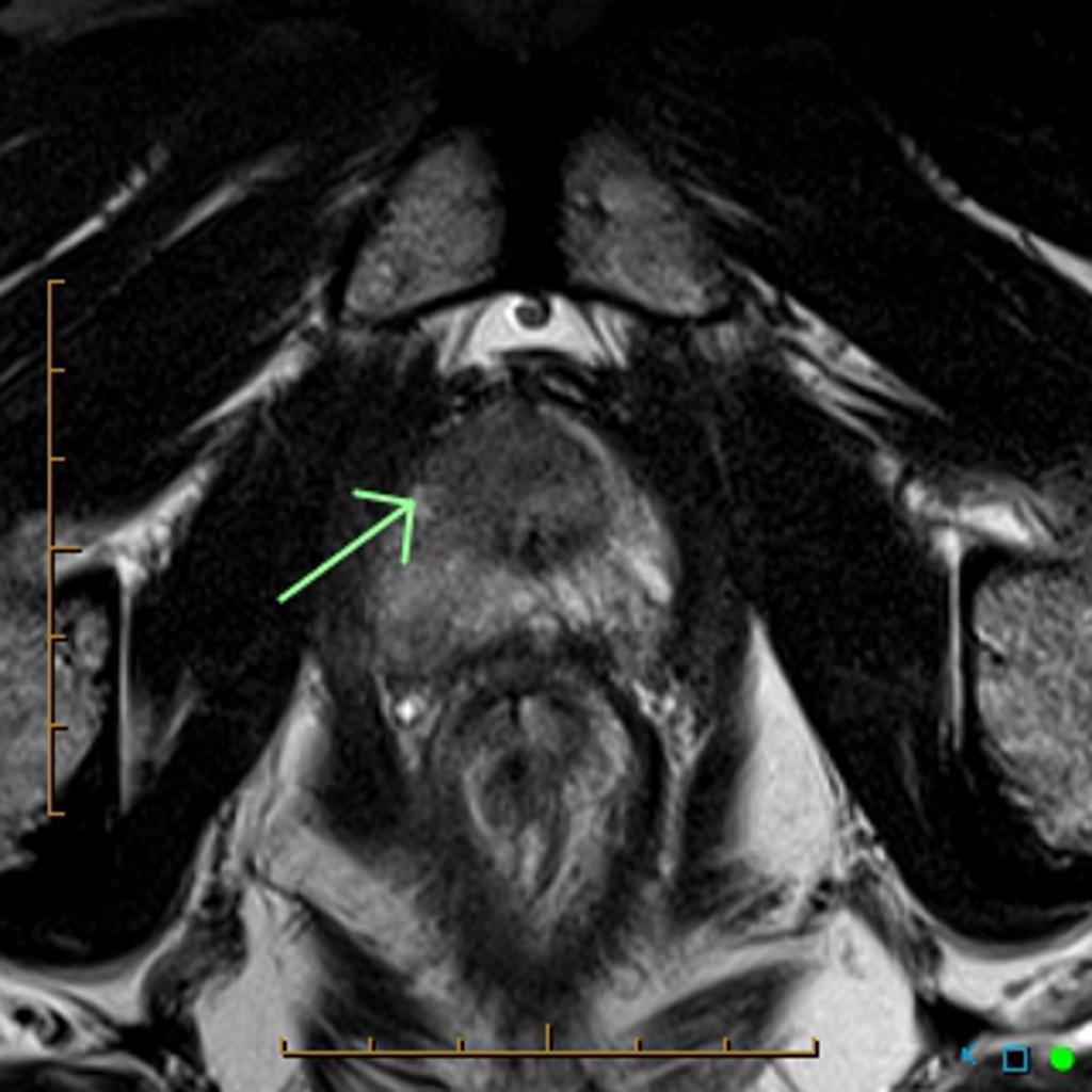 File:Prostate-cancer-multiparametric-imaging-on-3-t-mri.jpg