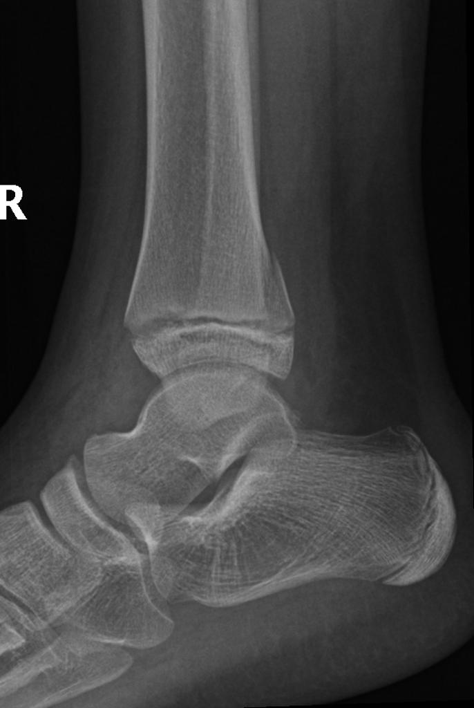 File:Salter-Harris type II injury of ankle.jpg