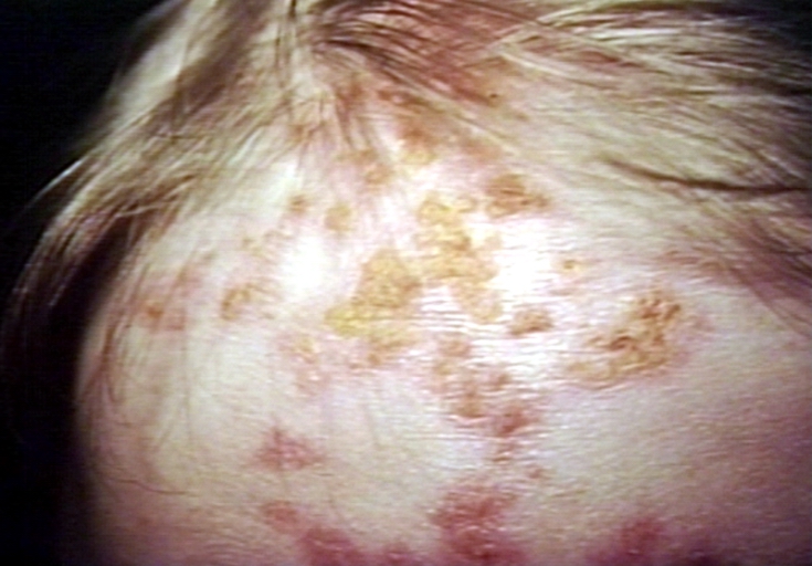 Skin: alopecia, secondary lupus erythematosus; hair loss