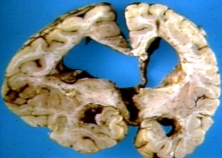Brain: Arnold Chiari Malformation with Hydrocephalus