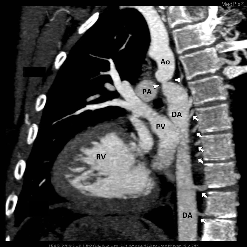 File:CT Angiography Coarctation of Aorta Flipped and Labelled Image 5.jpg