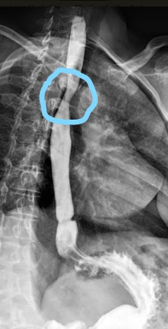 File:Esophageal stricture.jpg