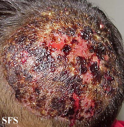.kerion celsi Adapted from Dermatology Atlas.[1]