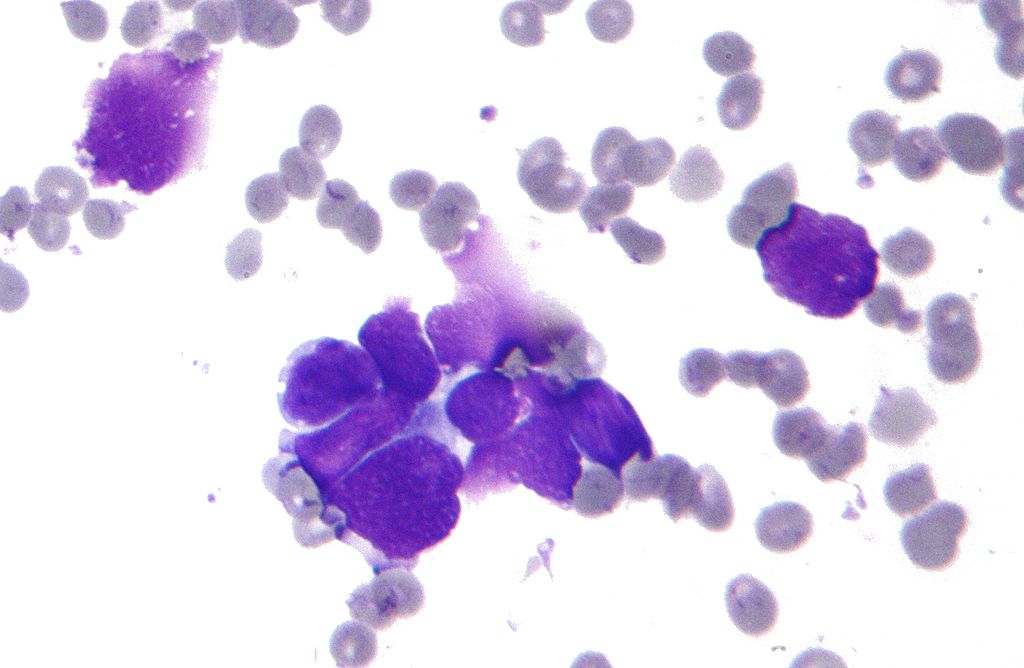Micrograph of a small-cell carcinoma of the lung showing cells with nuclear molding, minimal amount of cytoplasm and stippled chromatin. FNA specimen. Field stain.